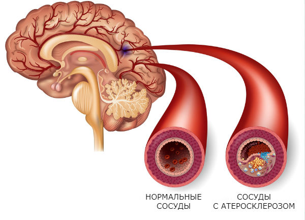 атеросклероз сосудов головного мозга