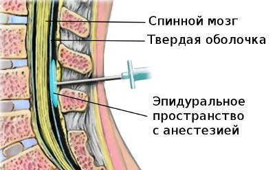 Эпидуральная блокада