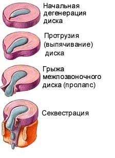 Стадии формирования грыжи